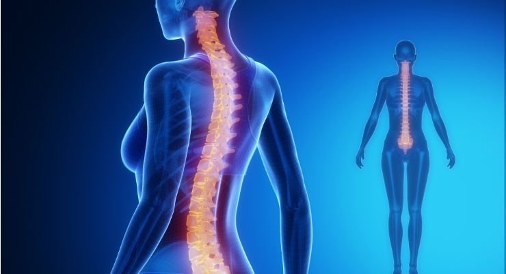 Back Surgery at L5-S1 (Infographic)